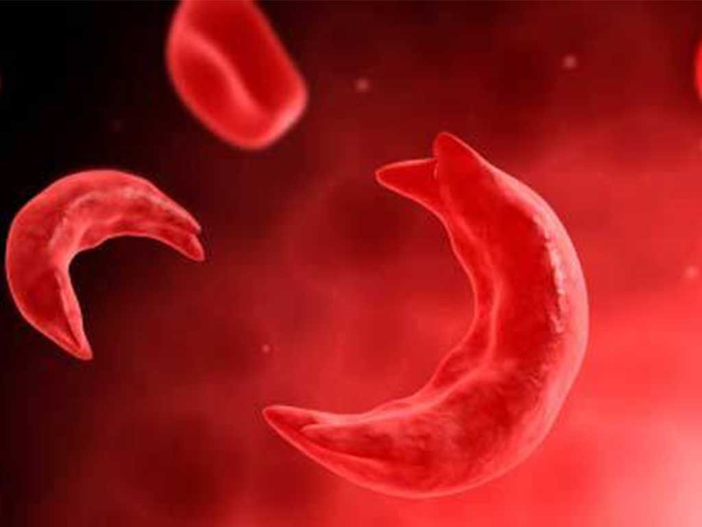 थारू समुदायका १२ प्रतिशतलाई सिकलसेल