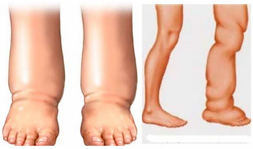 आजदेखि हात्तीपाइलेको औषधी खुवाइँदै